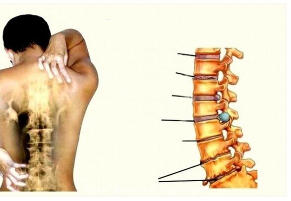 Etapas da osteocondrose cervical