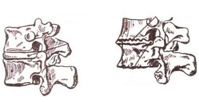Etapas de desenvolvemento da osteocondrose cervical
