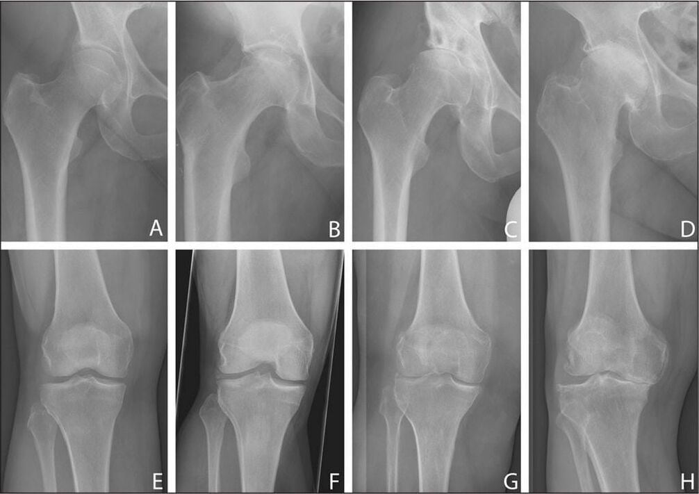 Etapas do desenvolvemento da artrose articular nunha radiografía