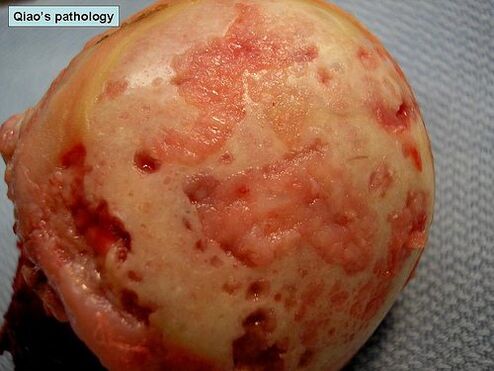 Superficie cartilaxinosa afectada por artrose